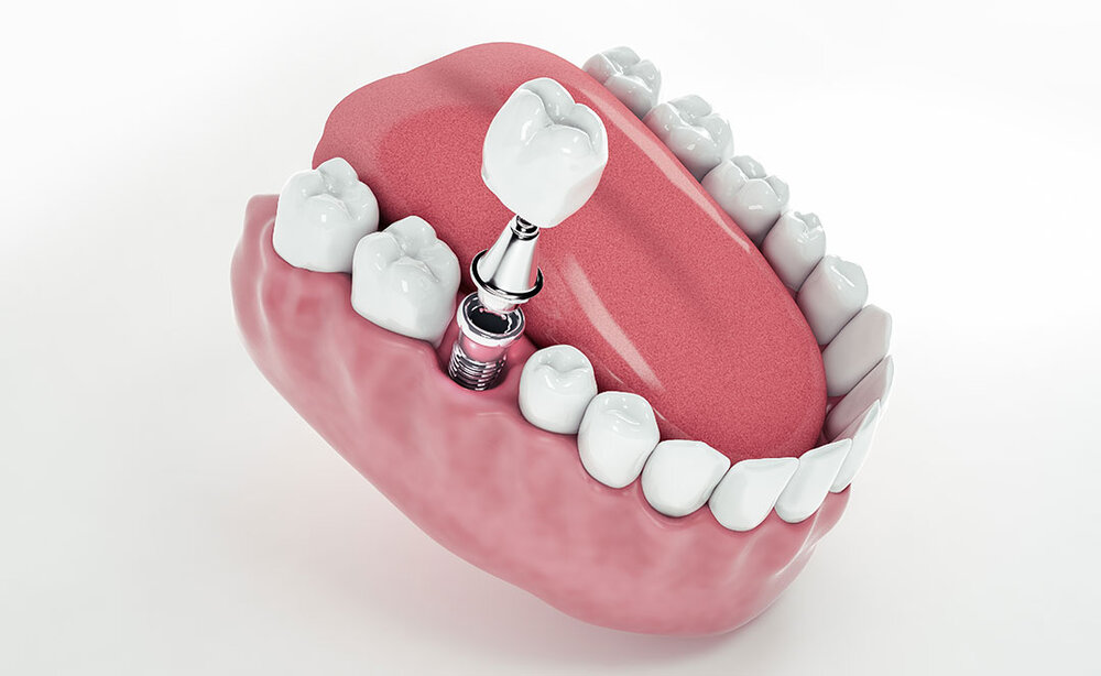 قیمت ایمپلنت تک دندان