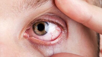 علت خشکی چشم چیست؟ عوامل، عوارض و راهکارهای درمان