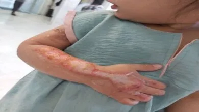 سوختگیها چهارمین علت مرگومیر در حوادث هستند سوختگیها چهارمین علت مرگومیر در حوادث هستند