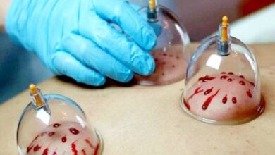 بدون مشورت پزشک حجامت انجام ندهید بدون مشورت پزشک حجامت انجام ندهید