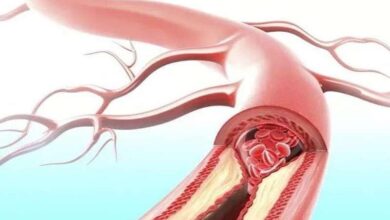نشانه‌های مسدود شدن رگ قلب