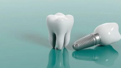 قیمت ایمپلنت دندان 1404